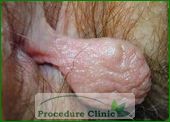 anal polyps